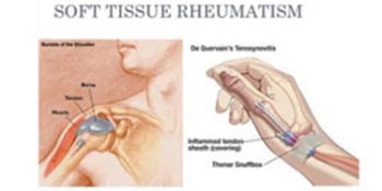 Soft tissue Rheumatology